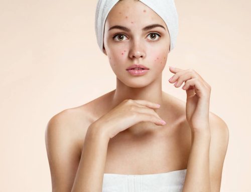 Acne Awareness: Myths and Truths Revealed