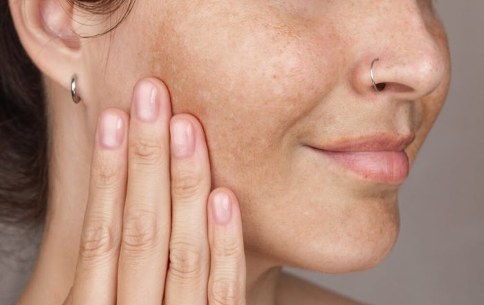 woman dark spots