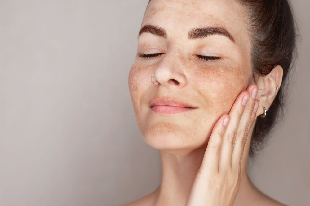 dark spots skin